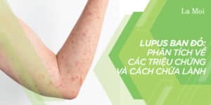 Lupus Ban Đỏ: Phân Tích Về Các Triệu Chứng Và Cách Chữa Lành