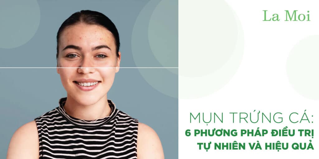 Mụn Trứng Cá: 6 Phương Pháp Điều Trị Tự Nhiên Và Hiệu Quả