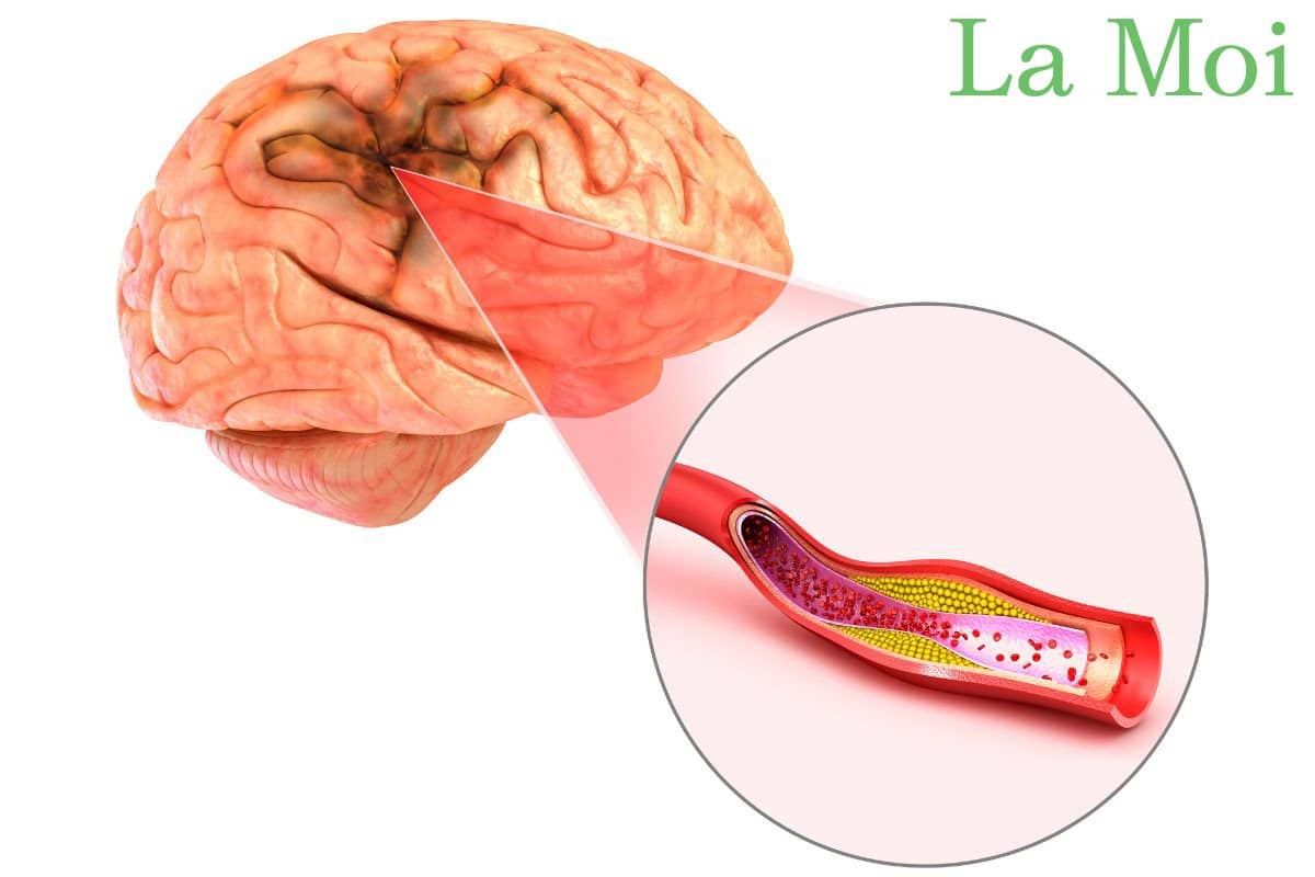Đột quỵ còn được gọi là tai biến mạch máu não