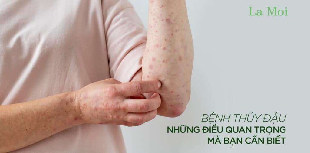 Bệnh thủy đậu: Những điều quan trọng mà Bạn cần biết