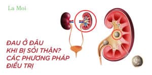 Đau ở đâu khi bị sỏi thận? Các phương pháp điều trị